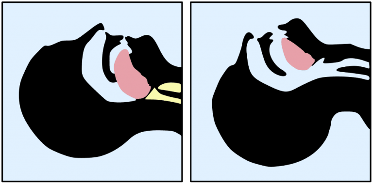 7 Health Risks of Mouth Breathing During Sleep